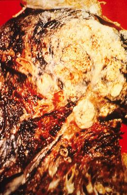 Close up of cancerous lung